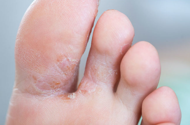 how to get rid of an athlete's foot