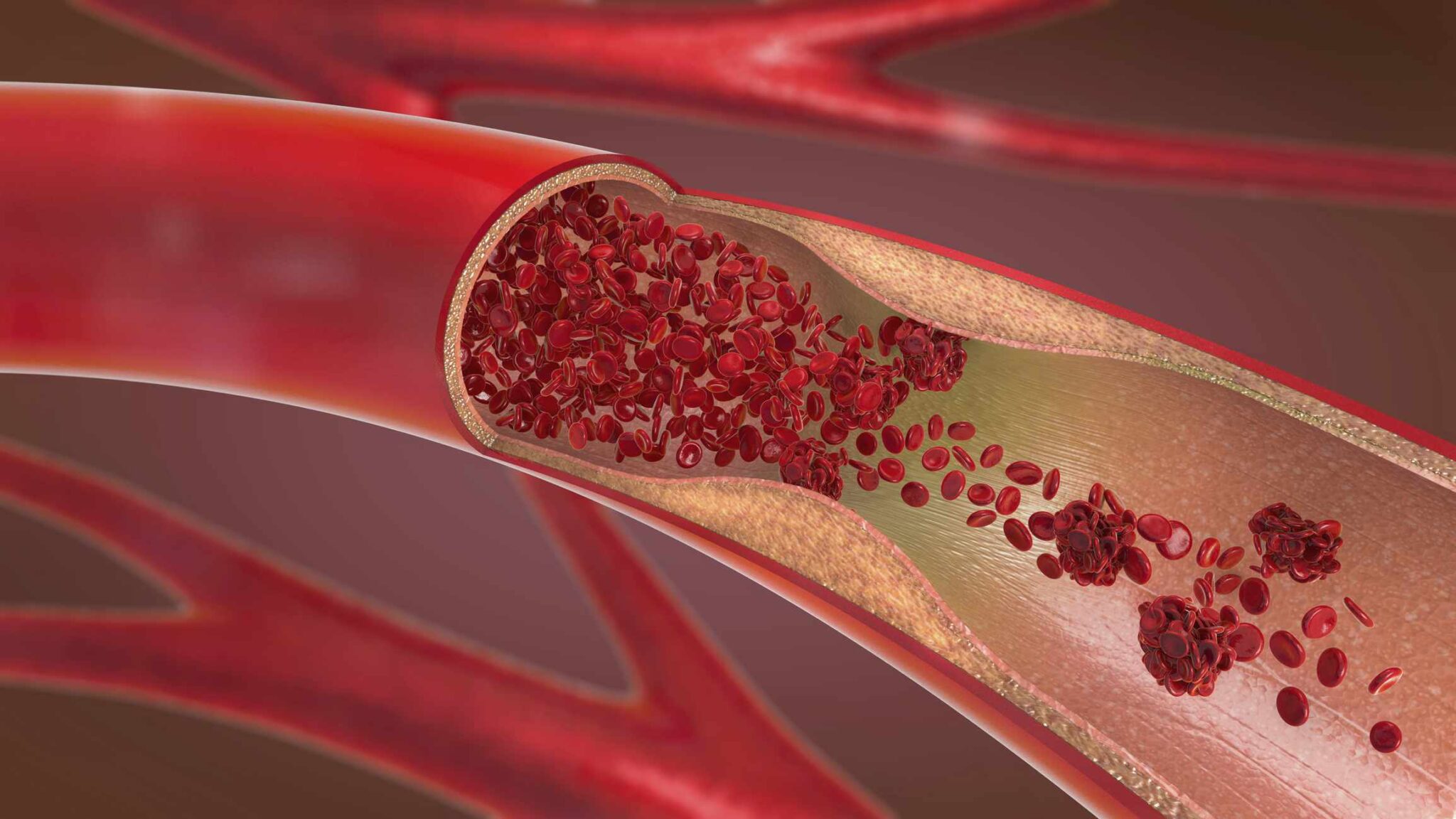 Does Hardening Of The Arteries Cause Pain