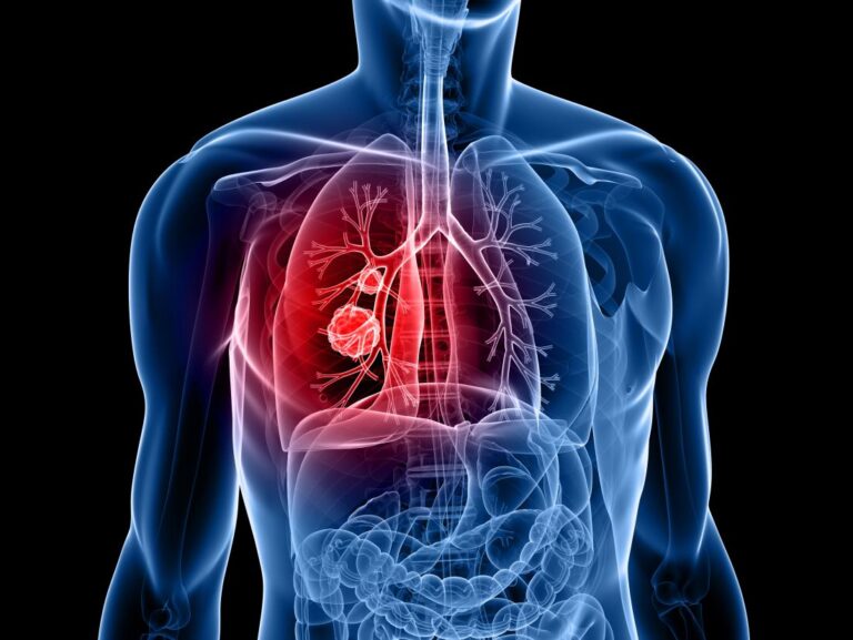 Lung Cancer Disease A Detailed Overview Wellness And Health Tips 5697