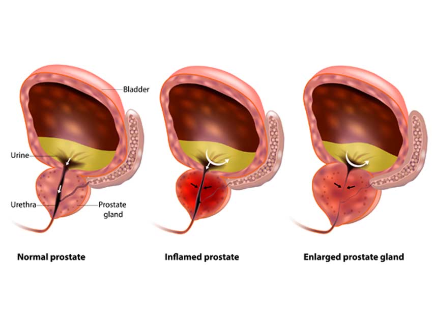 prostate cancer