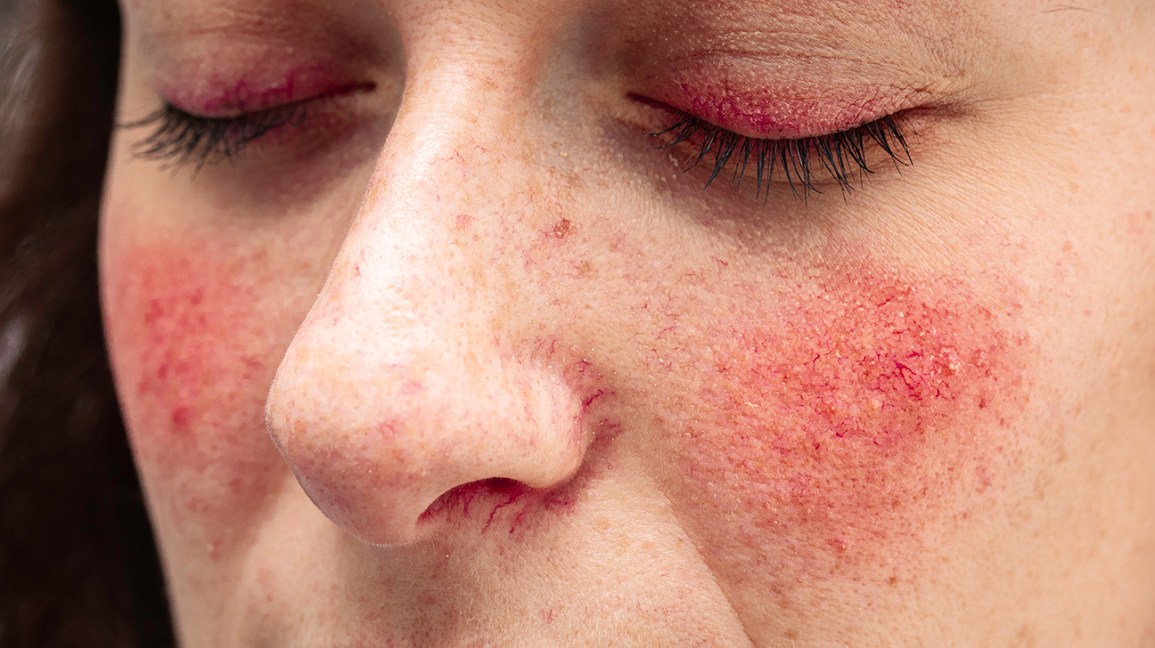 types of rosacea rashes