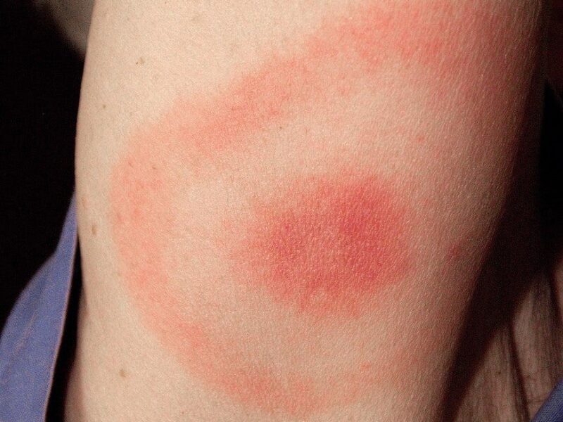 lyme disease