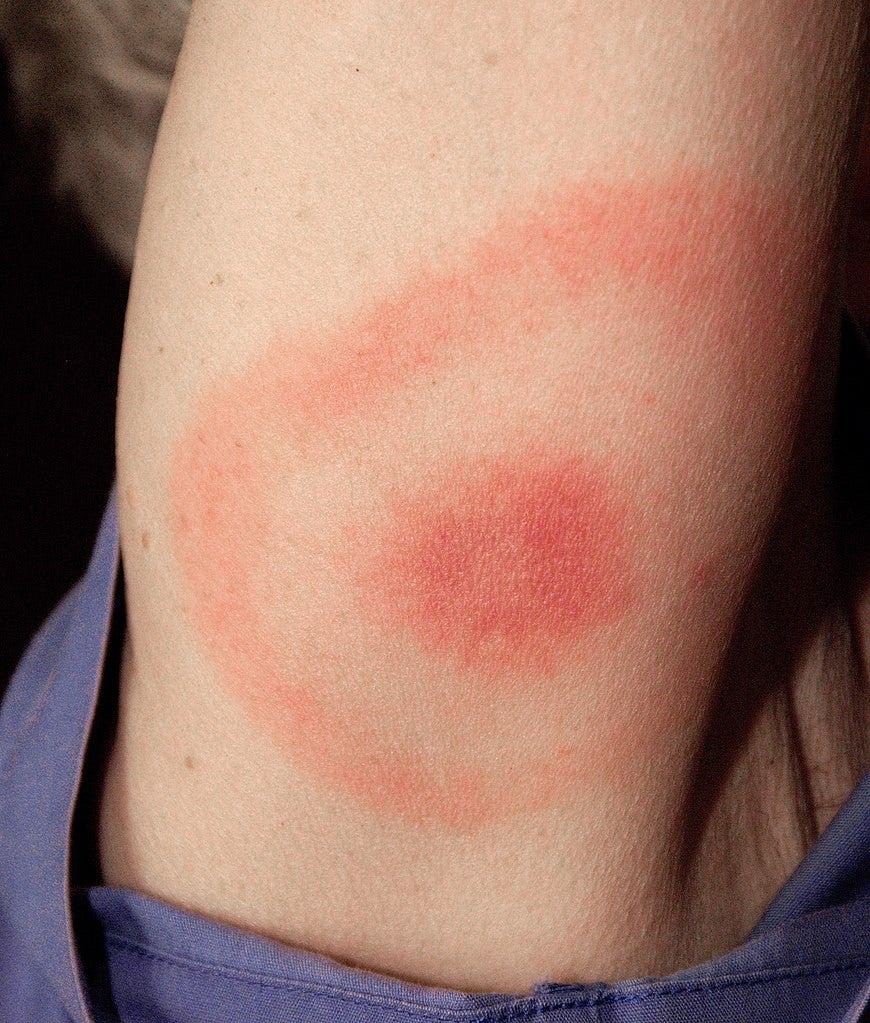 lyme disease