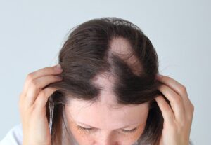 Patchy hair loss due to alopecia areata