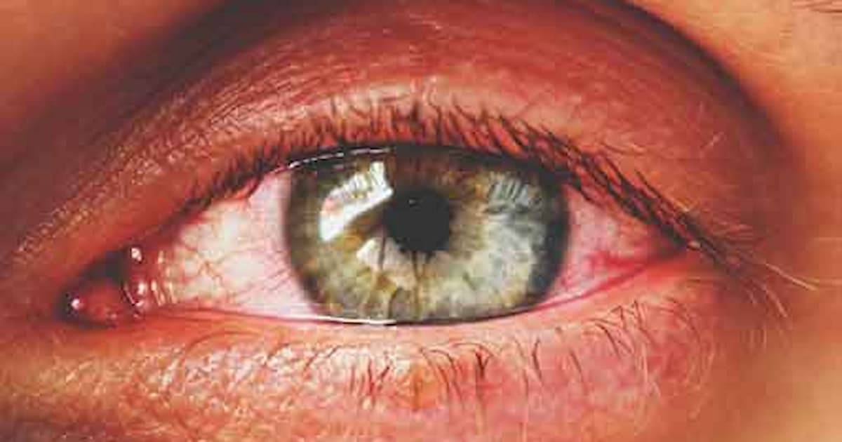 Close-up of irritated red eye due to pink eye conjunctivitis